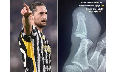 Rabiot (Juventus), infortunio: foto del dito sui social, cosa si è fatto e quando rientra