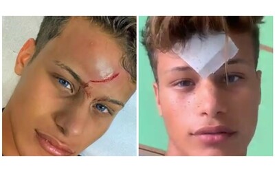 Denis Dosio ferito al volto in Grecia, assolto il 27enne che lanciò il bicchiere: “A Mykonos usano solo quelli di plastica”