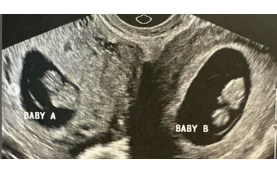 Donna con due uteri resta incinta in entrambi: c’era 1 possibilità su un...