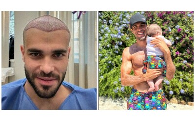 Goffredo Cerza, il compagno di Aurora Ramazzotti si è fatto il trapianto di capelli: le foto dopo l’intervento