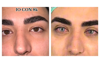 “Ho speso 8000 euro per cambiare il colore degli occhi. L’operazione è molto invasiva ma ho realizzato un sogno”: la storia del tiktoker Lucky John (e le critiche)
