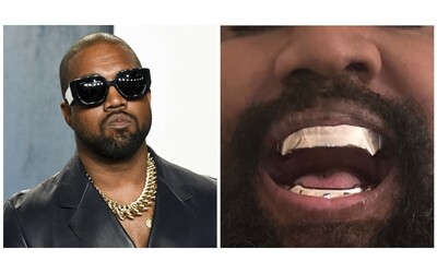 Kanye West si fa togliere tutti i denti per mettere una costosissima affilata protesi in titanio: l’operazione da 1 milione di dollari