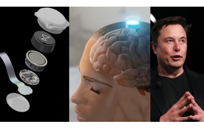 chip neuralink primo impianto su essere umano