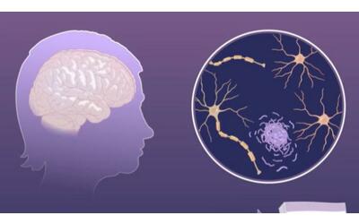 Alzheimer, i cambiamenti  silenzioni nel cervello che precedono la malattia ...