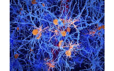 Alzheimer, la proteina Kibra potrebbe invertire i problemi di memoria
