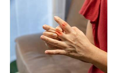 Artrite reumatoide, quanto contano gli ormoni femminili e le abitudini poco salutari