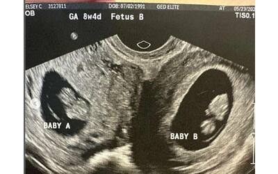 Donna con doppio utero è incinta in entrambi: era una possibilità su 50...