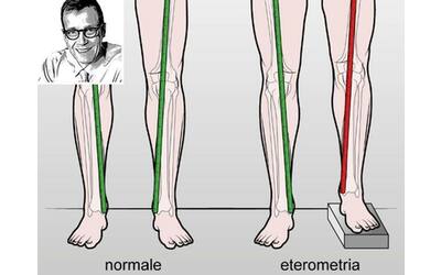 gambe di lunghezza diversa una protesi pu risolvere il problema in via definitiva