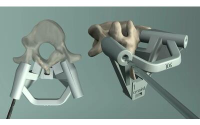 stampa 3d per la colonna vertebrale cos i pezzi di ricambio fungono da nuova impalcatura