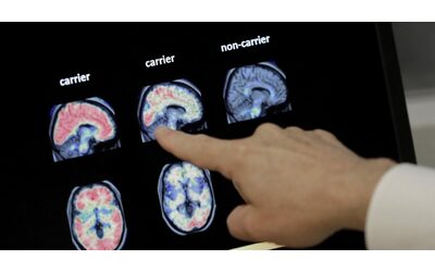 Alzheimer, scoperto un meccanismo cellulare chiave della malattia. Lo studio degli scienziati Usa