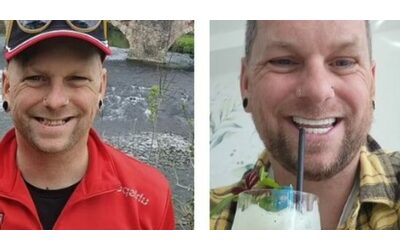 “Consumavo 21 lattine di bibite gassate a settimana e non andavo dal dentista da 10 anni. Un giorno mi è caduto un dente all’improvviso e ho deciso di andare in Turchia”: la storia di Nicholas Mudford