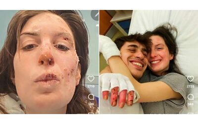 Dietro ogni articolo e ogni titolo di giornale c stata la vita vera Eleonora Palmieri mostra sui social il volto ustionato nel rogo di Crans Montana