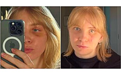 Ho una placca di titanio sotto l occhio e la mia vista potr rimanere per sempre offuscata le conseguenze della caduta a Milano Cortina