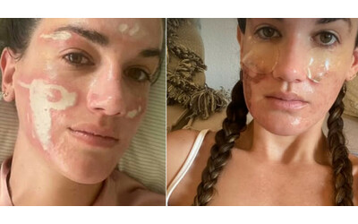 “L’estetista di Jennifer Lopez mi ha rovinato la pelle. Mi ha fatto spendere 30mila dollari e ho ustioni e cicatrici permanenti”: la storia di Victoria Nelson