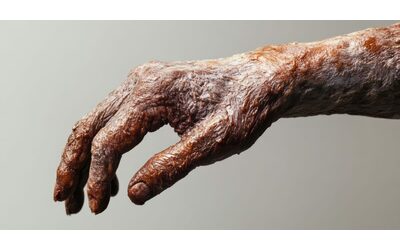 La lebbra torna in Europa segnalati casi in Romania e Croazia L esperto Effetto degli spostamenti globali delle persone