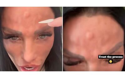 “Mi sono spuntate delle gobbe sulla fronte”: Katie Price mostra il suo viso dopo il...