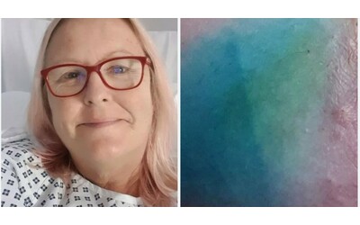 “Mi sono svegliata e il mio seno era blu. Nessuno te lo dice”. La storia della battaglia contro il cancro di Beverley Godsell, soprannominata dagli amici “Puffetta”