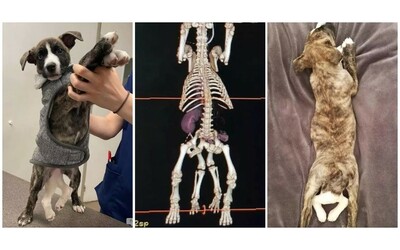 “Nel suo corpo c’era anche il suo gemello mai sviluppato”: l’incredibile storia di Mila,...