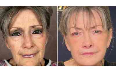 Sono quasi morta per un embolia polmonare Il mio volto ero solo pelle e ossa ora invece dimostro 30 anni di meno Ho dovuto ricredermi sulla chirurgia estetica la storia di Mae