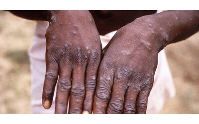 Virus Mpox (Vaiolo delle scimmie), 7 contagiati in Friuli: infettata famiglia con tre adulti e due bambini