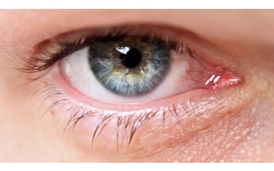 Nuovo sistema per lo screening del glaucoma: l’intelligenza artificiale trasforma la diagnostica