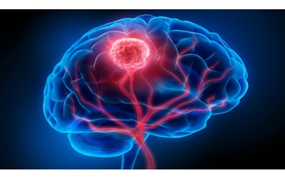 Tumori cerebrali la nuova frontiera dell IA con un modello ibrido rivoluzionario